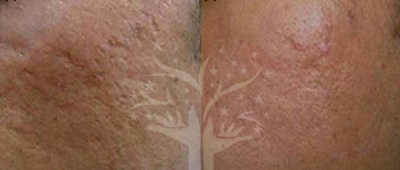 acne scar reduction treatment in gurgaon